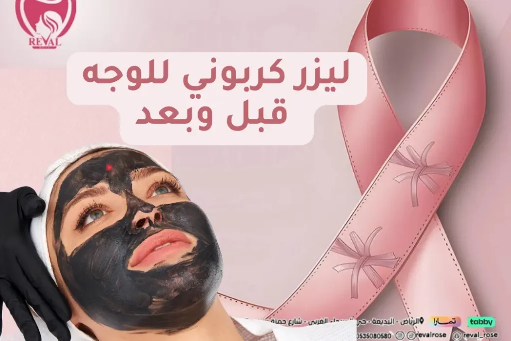 ليزر كربوني للوجه قبل وبعد:  تجربتي مع التقشير الكربوني للوجه بالرياض