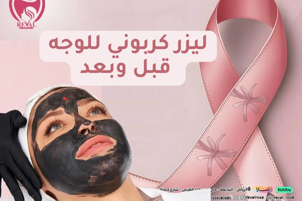 ليزر كربوني للوجه قبل وبعد ليزر كربوني للوجه قبل وبعد: تجربتي مع التقشير الكربوني للوجه بالرياض