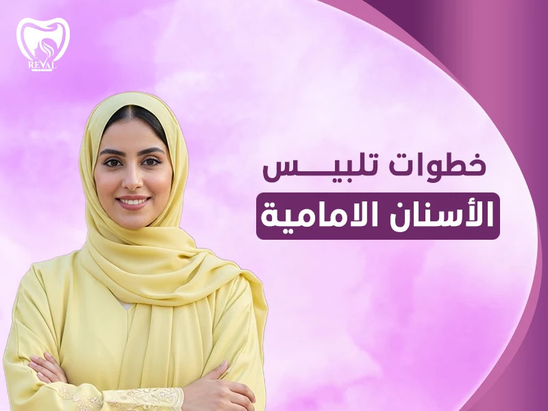 خطوات تلبيس الأسنان الأمامية: كم من الوقت يستغرق تلبيس الأسنان؟