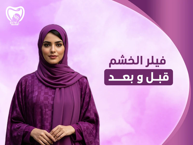 فيلر الخشم قبل وبعد بالرياض- كم مدة بقاء فيلر الأنف؟