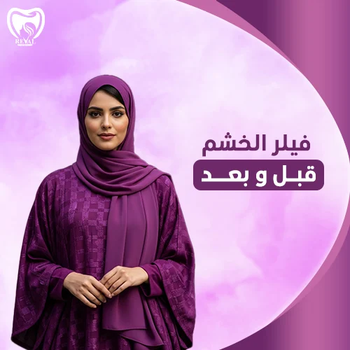 تجربتي مع فيلر الخشم 