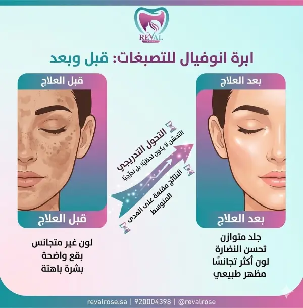 ابرة انوفيال للتصبغات قبل وبعد