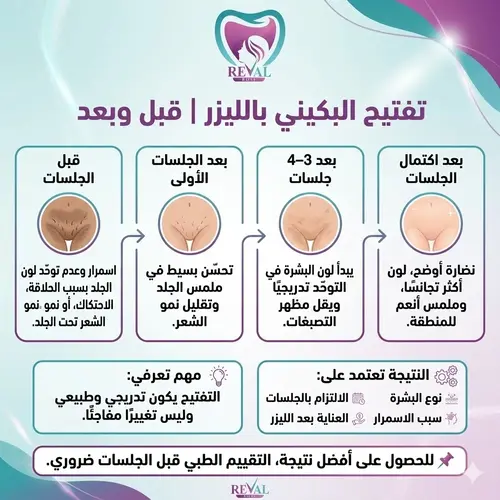 تعليمات بعد ليزر توريد البكيني_ تفتيح البكيني قبل وبعد