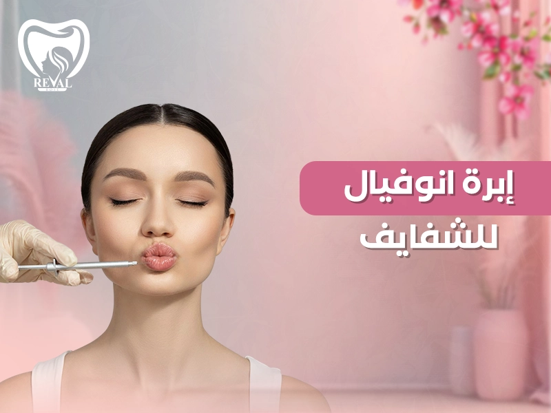 ابرة انوفيال للشفايف: كم يستمر مفعول ابرة الأنوفيال؟