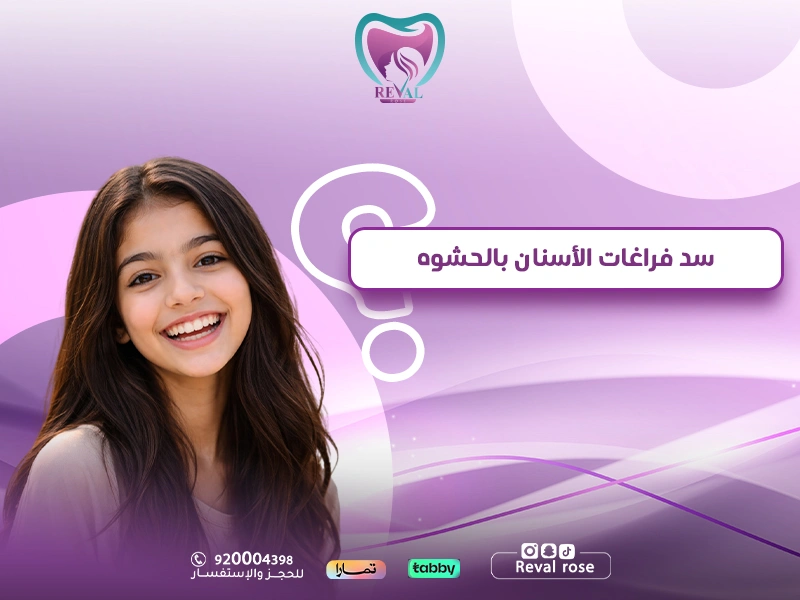 سد فراغات الأسنان بالحشوه: أفضل حل تجميلي سريع لملء الفراغات واستعادة تناسق الابتسامة
