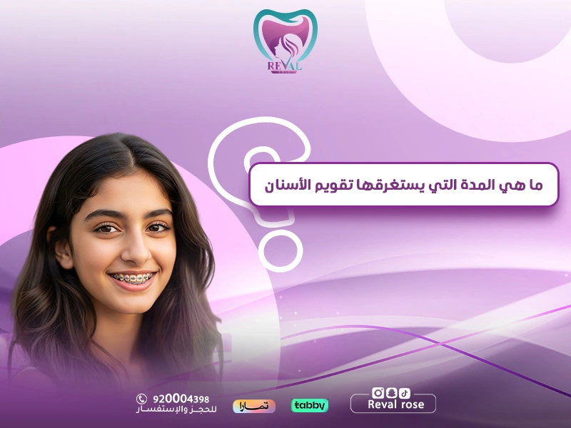 ما هي المدة التي يستغرقها تقويم الأسنان