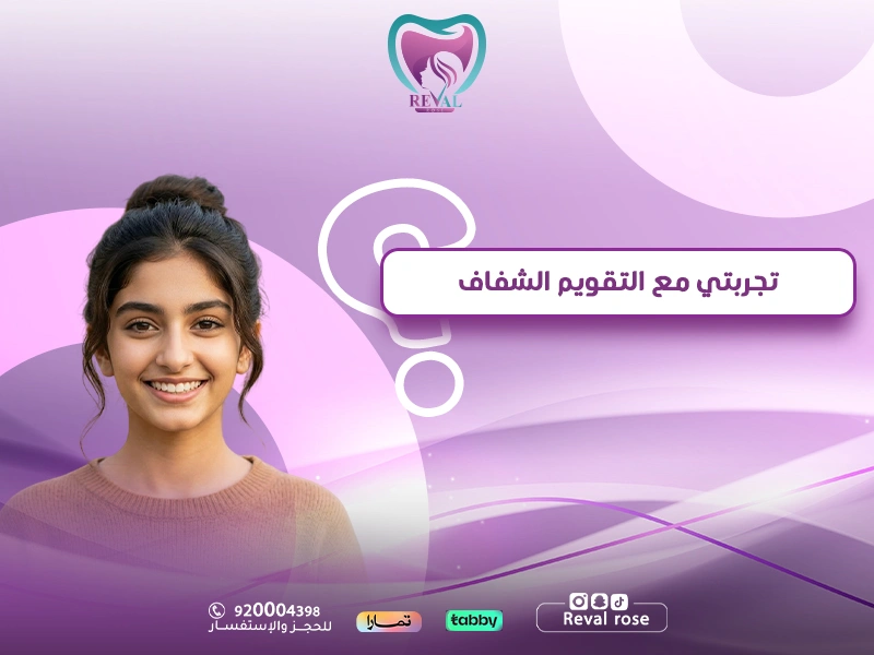 تجربتي مع التقويم الشفاف — تعليمات قبل وبعد تركيب تقويم الاسنان