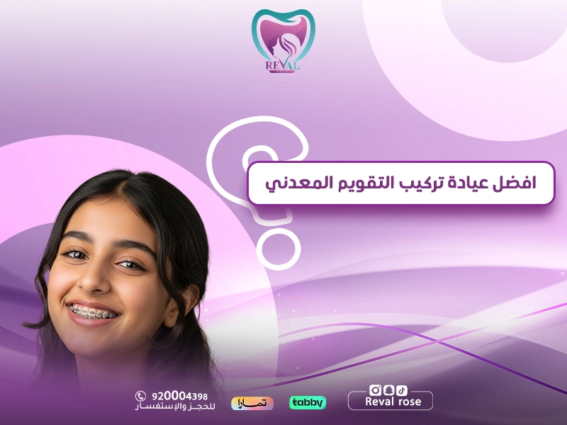 أفضل عيادة تركيب التقويم المعدني — كيف تختار أفضل دكتور تركيب تقويم معدني