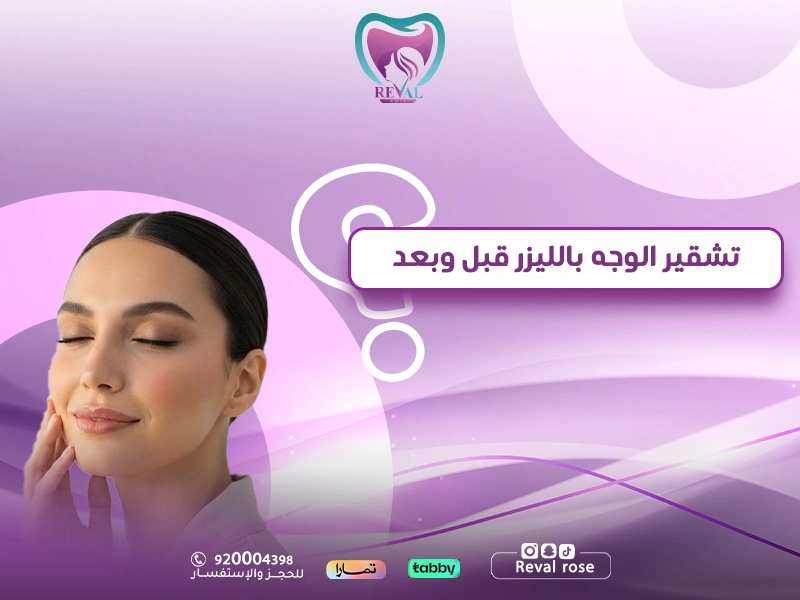 تشقير الوجه بالليزر قبل وبعد: كم جلسة تشقير يحتاج الوجه؟