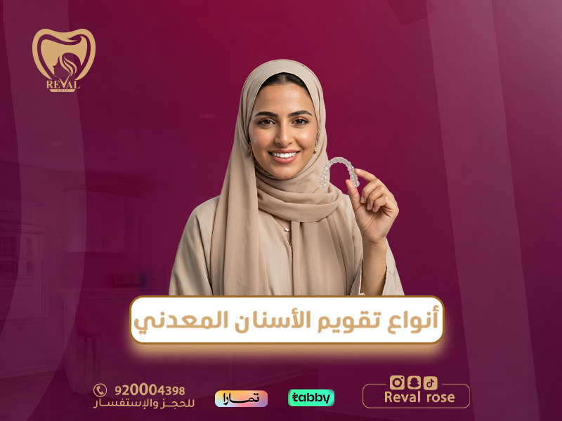 أنواع تقويم الأسنان المعدني: خصم تركيب التقويم بالرياض