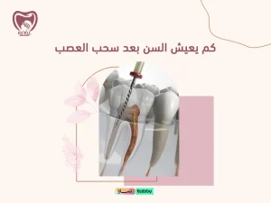 كم يعيش السن بعد سحب العصب؟ نصائح لزيادة المدة والحفاظ على السن