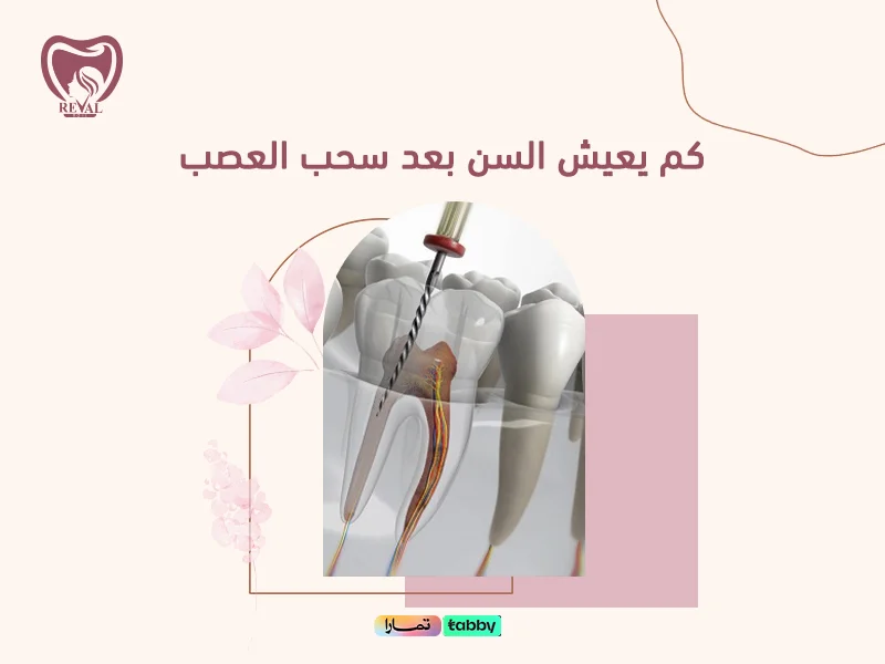 كم يعيش السن بعد سحب العصب؟ نصائح لزيادة المدة والحفاظ على السن