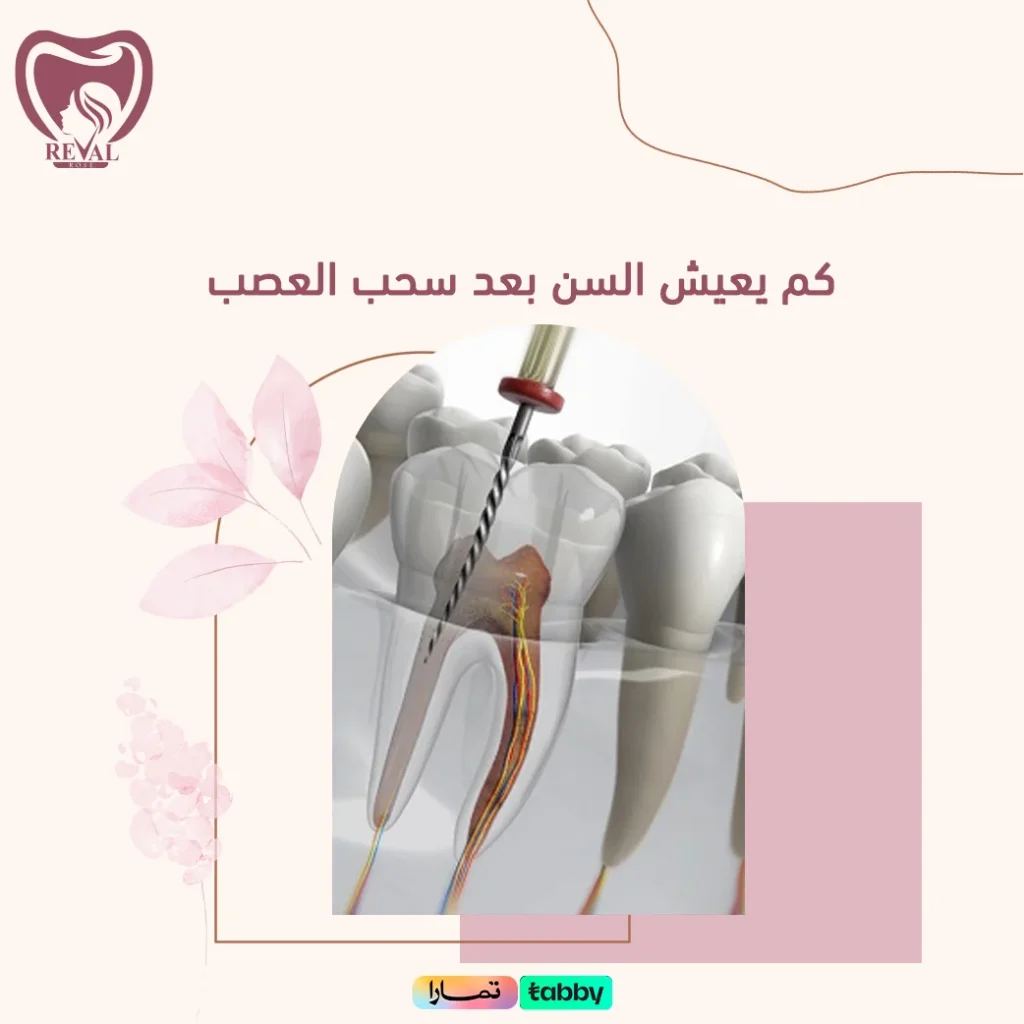 كم يعيش السن بعد سحب العصب؟