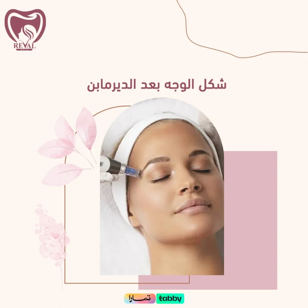 تجربتي مع الديرمابن