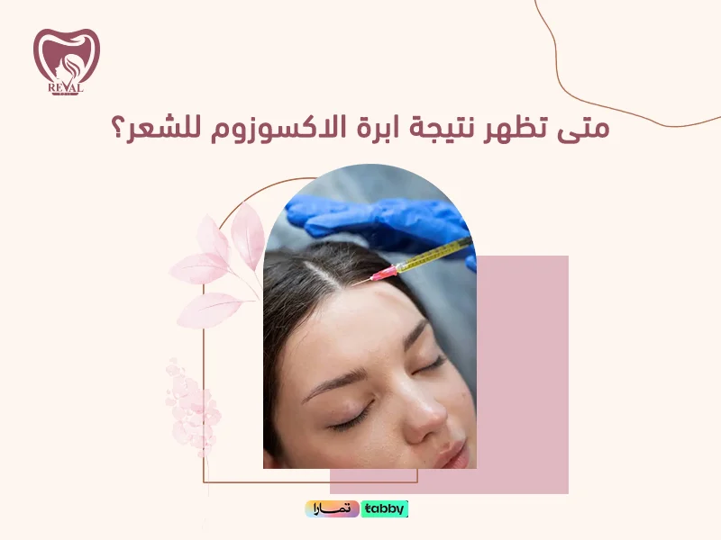 متى تظهر نتيجة ابرة الاكسوزوم للشعر؟ نصائح تعرف عليها قبل بدء العلاج