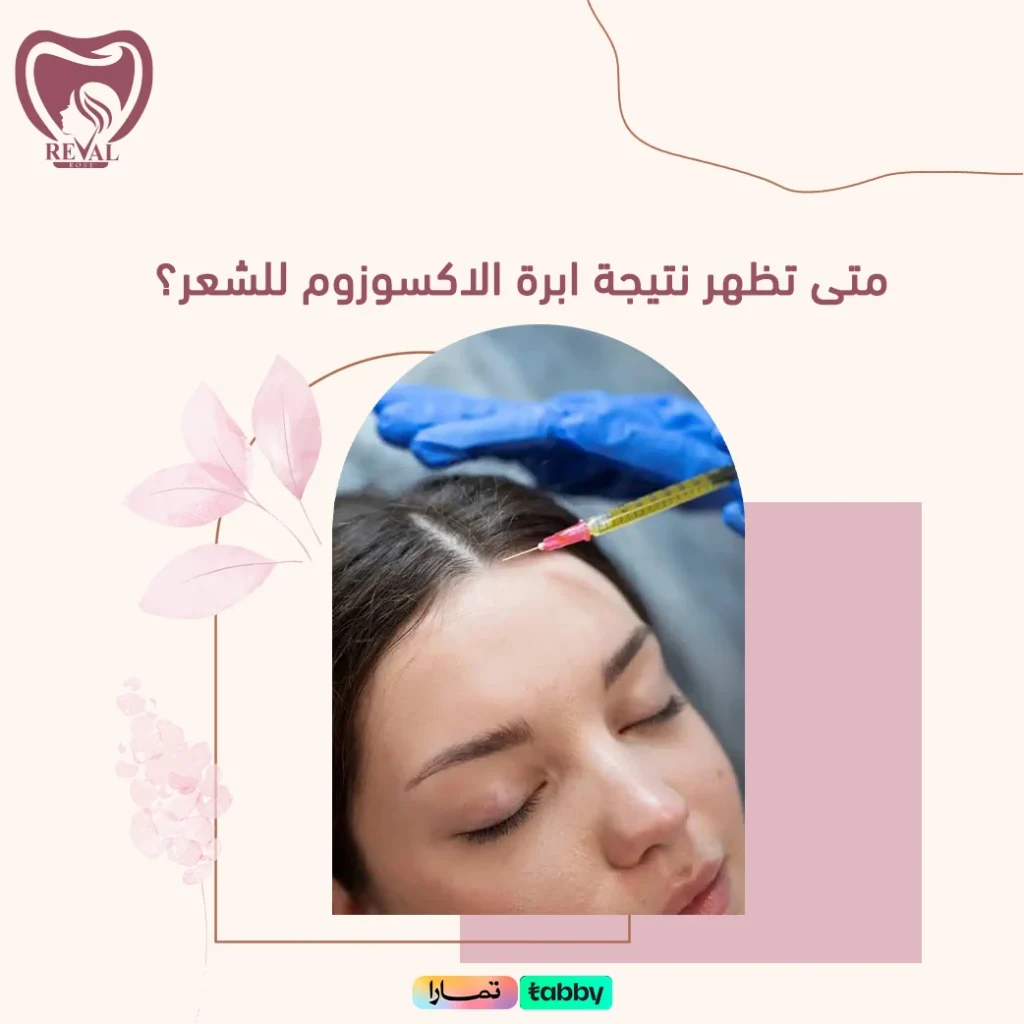 كم تدوم نتائج إبرة الاكسوزوم للشعر؟