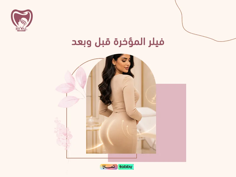 فيلر المؤخرة قبل وبعد