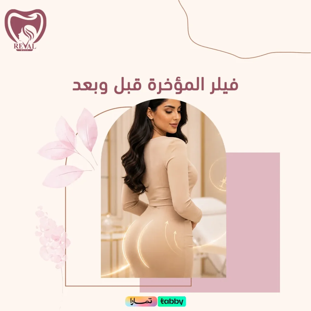 متى تظهر نتائج فيلر المؤخرة قبل وبعد؟