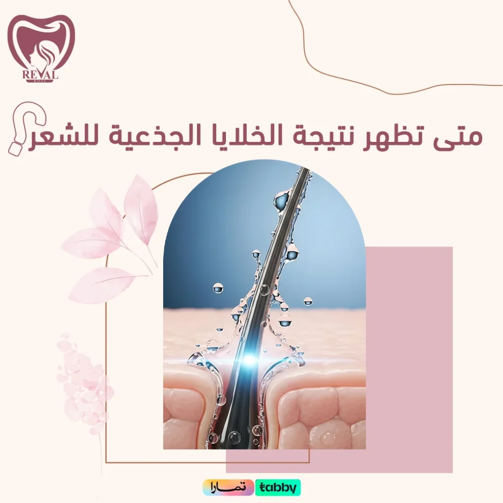 متى تظهر نتيجة الخلايا الجذعية للشعر؟