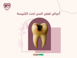 أعراض تعفن السن تحت التلبيسة: كيف تكتشف المشكلة قبل أن تتفاقم؟