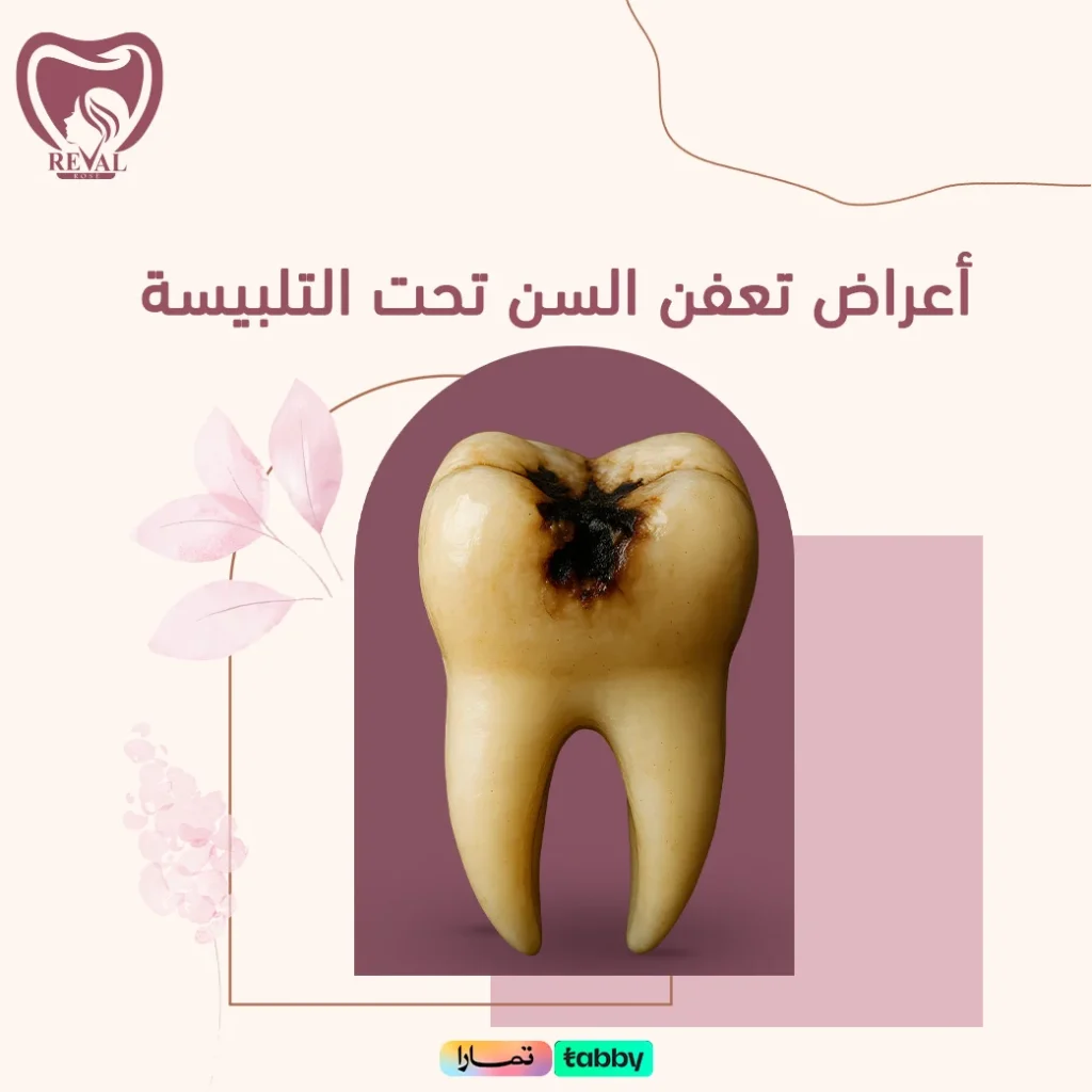 هل تعفن السن تحت التلبيسة قد يصل إلى العصب؟